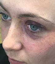 Bruised Eye Make-up Applied by an Iver Academy Trained Artist