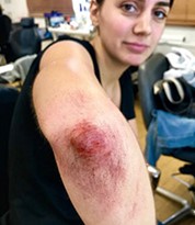 Elbow Bruise Make-up Applied by an Iver Academy Artist 